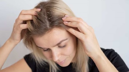 ತಲೆ ಹೊಟ್ಟಿಗೆ ನೈಸರ್ಗಿಕ ಮದ್ದುಗಳು..ಇವು ಡ್ಯಾಂಡ್ರಫ್‌ಗೆ ರಾಮಬಾಣ